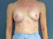 Example of breast implant deflation